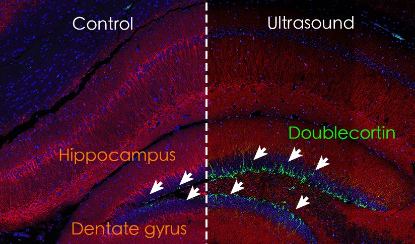 Figure 2: Doublecortin staining in mouse dentate gyrus was increased significantly after repeated ultrasound stimulation.