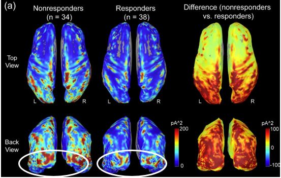 Nonresponders showed significantly augmented alpha intensity over occipital area (circled) compared to responders.