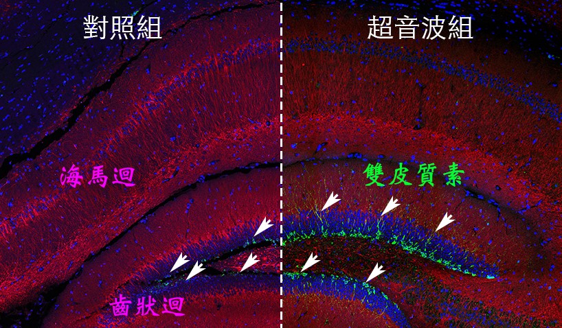 圖二：多次超音波刺激後的小鼠大腦齒狀廻，帶有雙皮質素的神經細胞顯著增加。